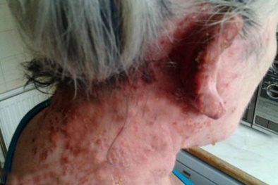 Mối nguy khó lường do thuốc nhuộm tóc gây ra